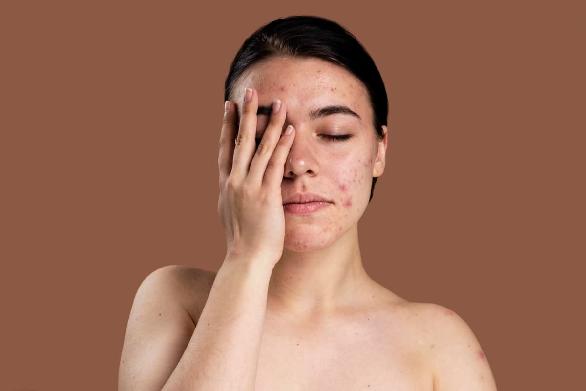Acne Acting Up Again? Tame It Naturally With Neem