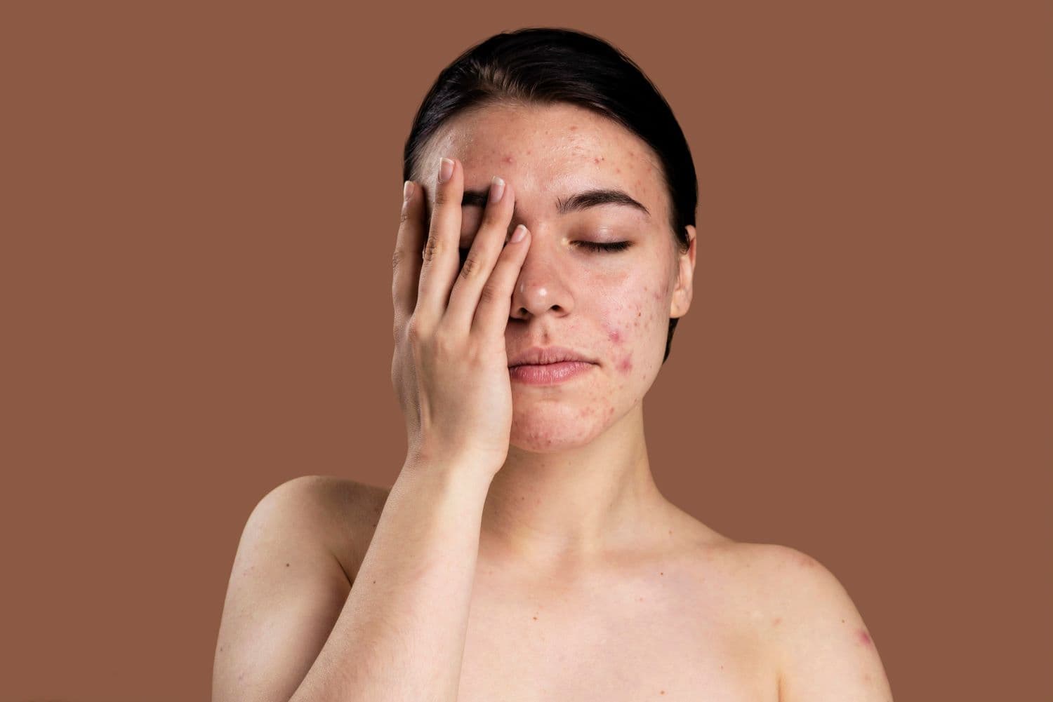 Acne Acting Up Again? Tame It Naturally With Neem